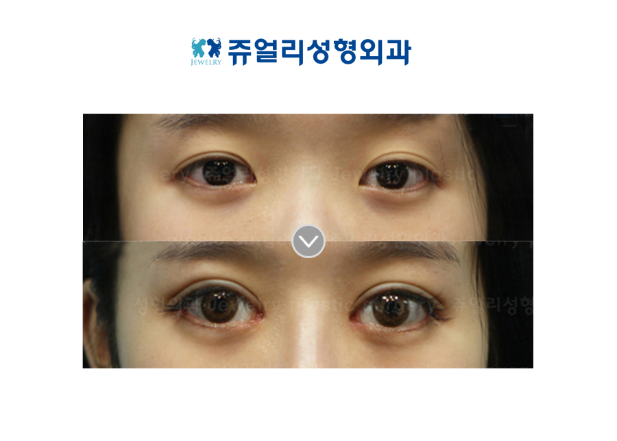 Double Eyelids Reoperation + Epicanthoplasty