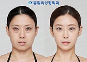 Lower Lateral Canthoplasty, Dark Circle Removal, Fat Grafting, Double Chin Liposuction, Chin Botox