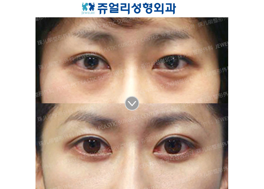 Double Eyelids + Dark Circle (Fat-Repositioning Transconjunctival)