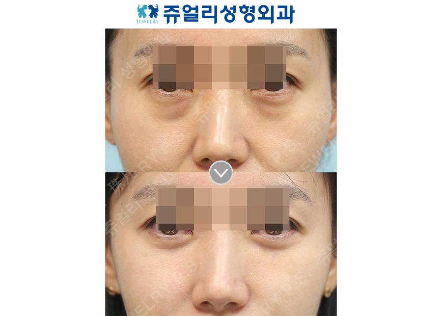 Lower blepharoplasty + midface lift
