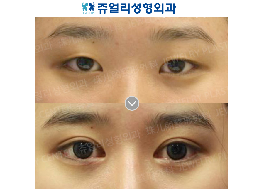 Double Eyelids Non-Incision