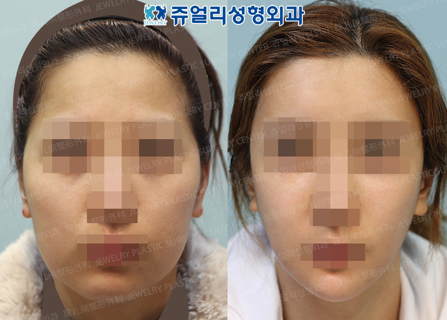 Cheekbone Reduction + Square Jaws Reduction + Front Chin Reduction