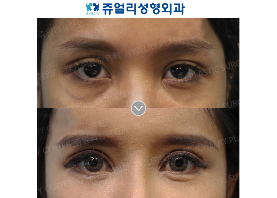Ptosis Correction + Epicanthoplasty + Lateral Canthoplasty + Dark Circles
