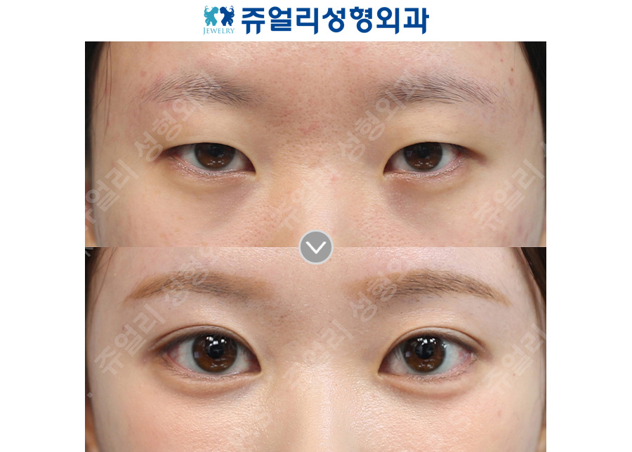 Double eyelid surgery + epicanthoplasty, lateral canthoplasty, lower canthoplasty + under-eye fat repositioning + aegyo-sal