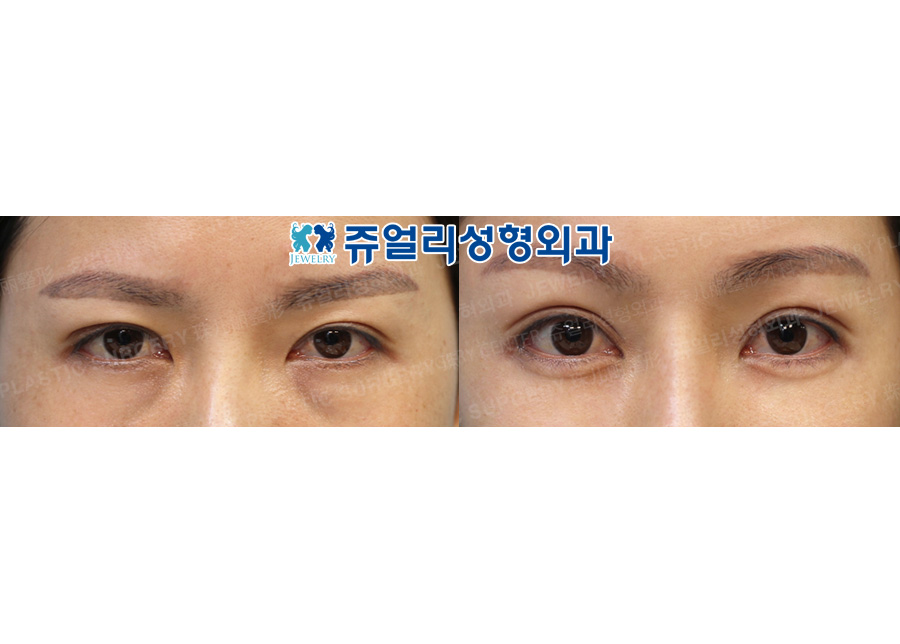 Forehead Lifting, Ptosis, Fat-Repositioning Transconjunctival, Nose Reoperation (Autogenous Rib Cartilage), Fat Grafting, Cheek + Jaw Liposuction, Jaw Muscle Lifting