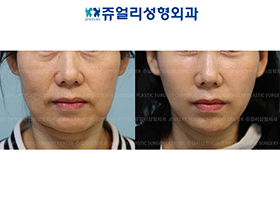 Mini Lifting (Jaw Line Lifting)