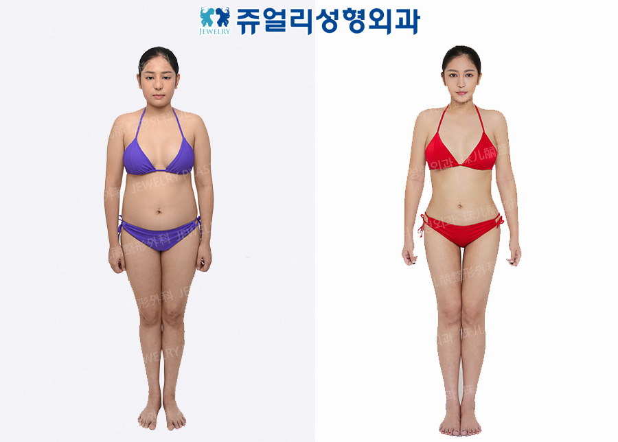 Cheek, Chin + Arm + Abdomen + Flank/Back + Waist + Thigh Liposuction