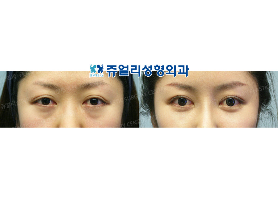 Double Eyelids + Dark Circle (Fat-Repositioning Transconjunctival)