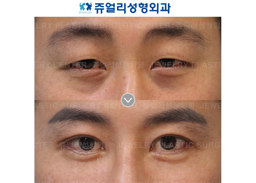 Ptosis (Eyes Enlargement)+ Dark Circle Removal (Fat-Repositioning)