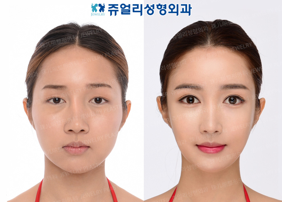 Double Eyelids (Ptosis), Lateral Canthoplasty, Dark Circle Removal+Loveband, Nose Reoperation, Fat Grafting, Cheek/Chin Liposuction, Cheekbone Reduction