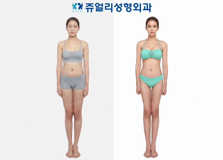 Liposuction (Thigh, Abdomen, Flank), Breast Surgery