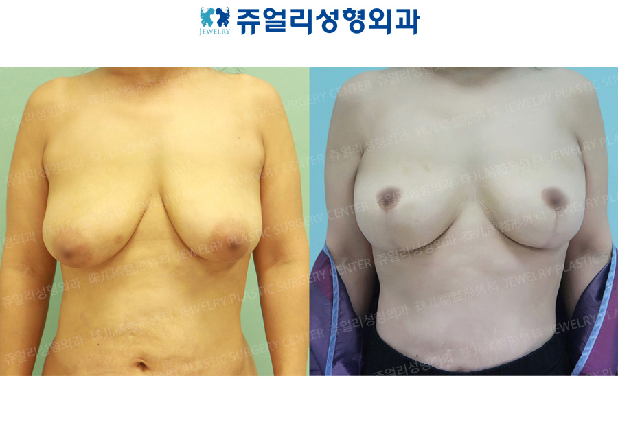 Breast Reduction + Lifting