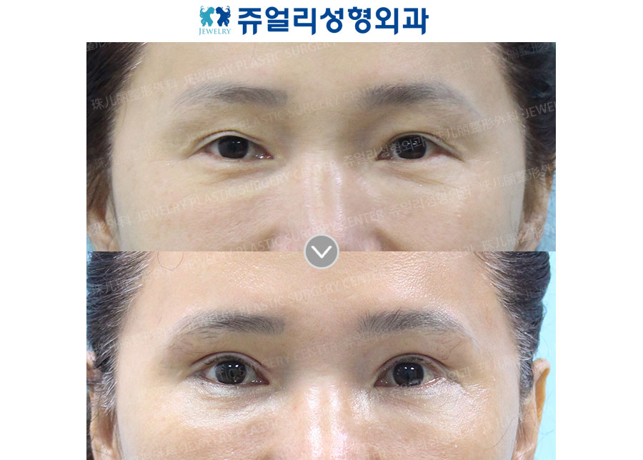 Upper Blepharoplasty (Reoperation)