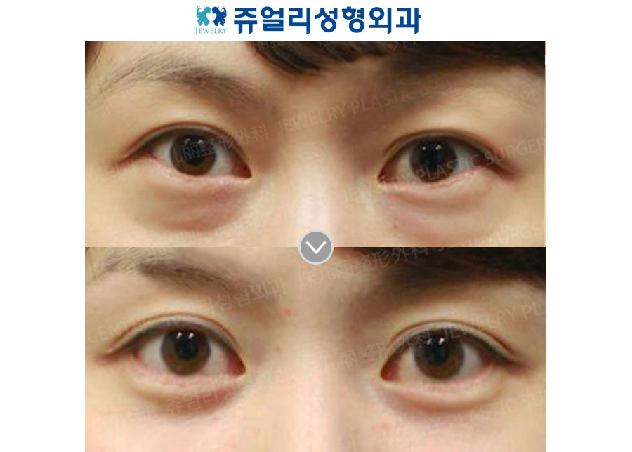 Fat-Repositioning Transconjunctival + Loveband