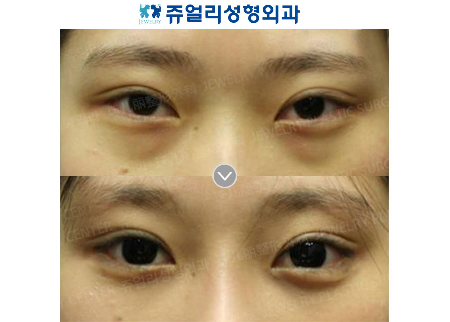 Fat-Repositioning Transconjunctival + Loveband