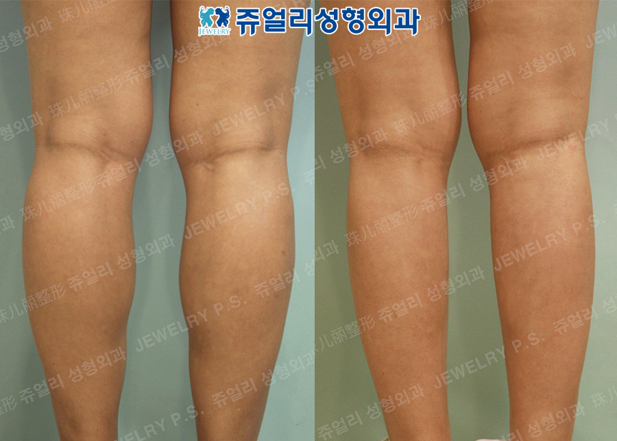 Calf Size Reduction High-Frequency (Nerve Block)