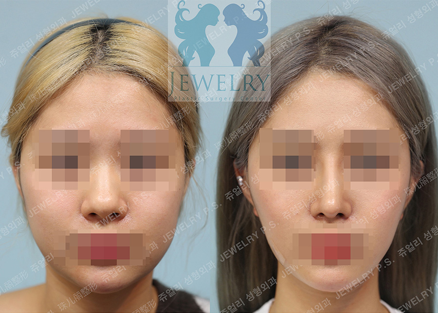 Cheek, Double Chin Liposuction