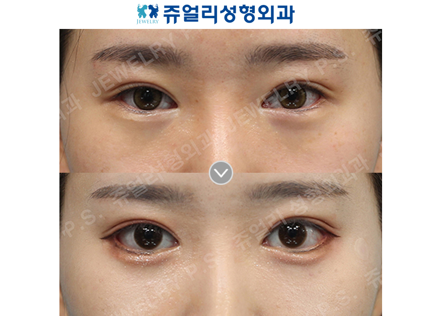 Dark Circle Removal (Fat Repositioning), Lateral Canthoplasty, Lower Lateral Canthoplasty