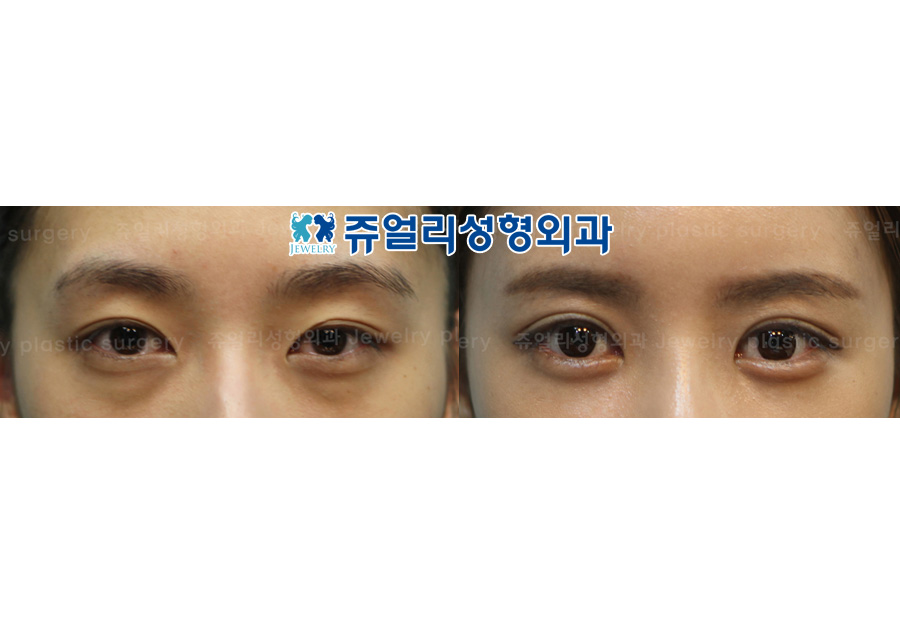 Non-Incision Double Eyelids + Dark Circles + Lovebands