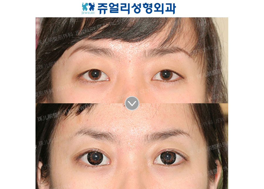 Double Eyelids