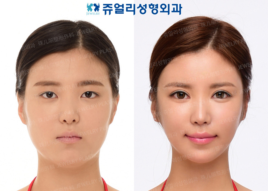 Double Eyelids Incision + Epicanthoplasty, Nose Reoperation(2nd time), Fat Grafting, Cheek/Chin Liposuction, Cheekbone Reduction