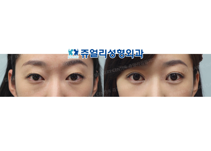 Double Eyelids+Dark Circle (Fat-Repositioning Transconjunctival)