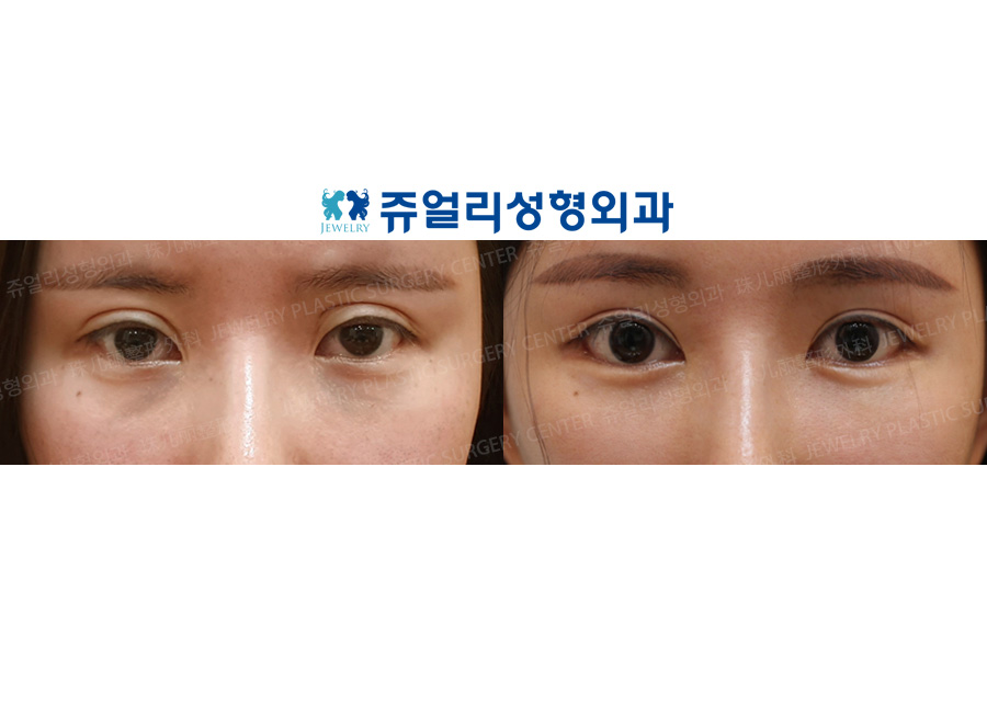 Double Eyelids Reoperation, Epi+Lateral+Lower Lateral Canthoplasty, Fat-Repositioning Transconjunctival