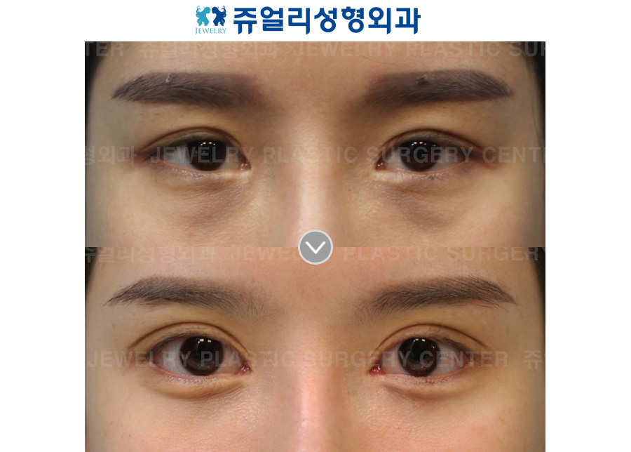 Ptosis (Eyes Enlargement)+ Dark Circle Removal (Fat-Repositioning)