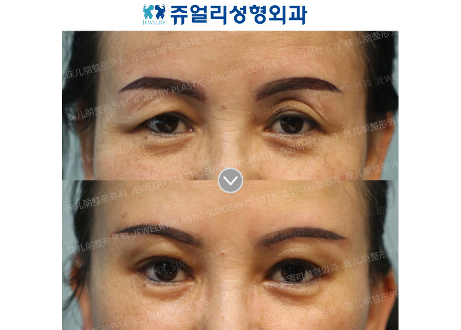 Brow Lifting + Eyelids Fat Grafting