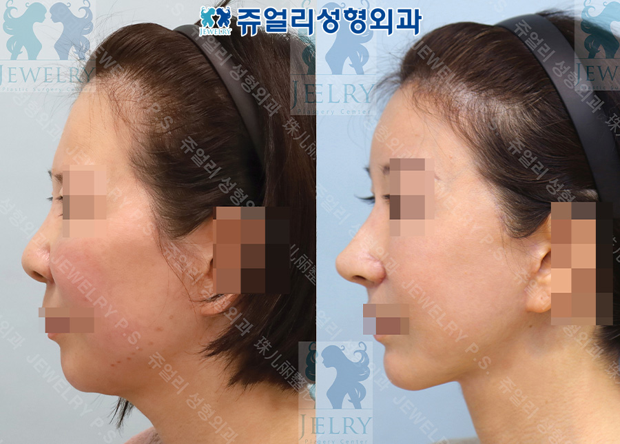 Facelift + neck lift + rhinoplasty (autologous rib cartilage) + bulbous nose correction + facial contouring (zygoma, square jaw, front chin reduction)
