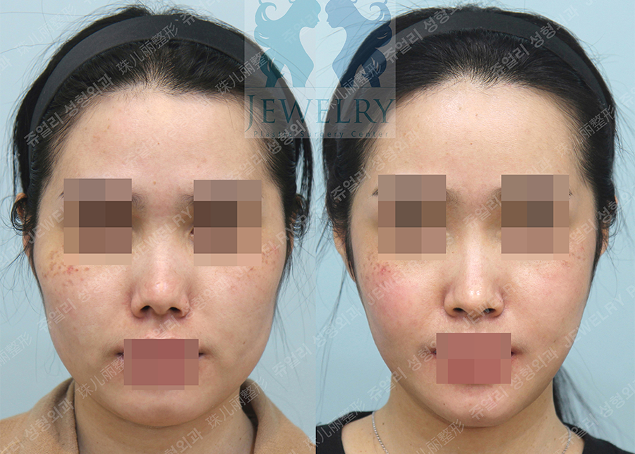 Cheek & Jaw Liposuction, Cheekbone Reduction, Square Jaw Reduction, T-osteotomy