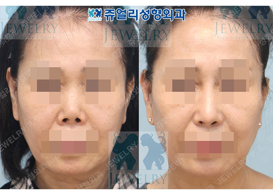 Revision rhinoplasty (contracted nose correction, nose lengthening, autologous rib cartilage)
