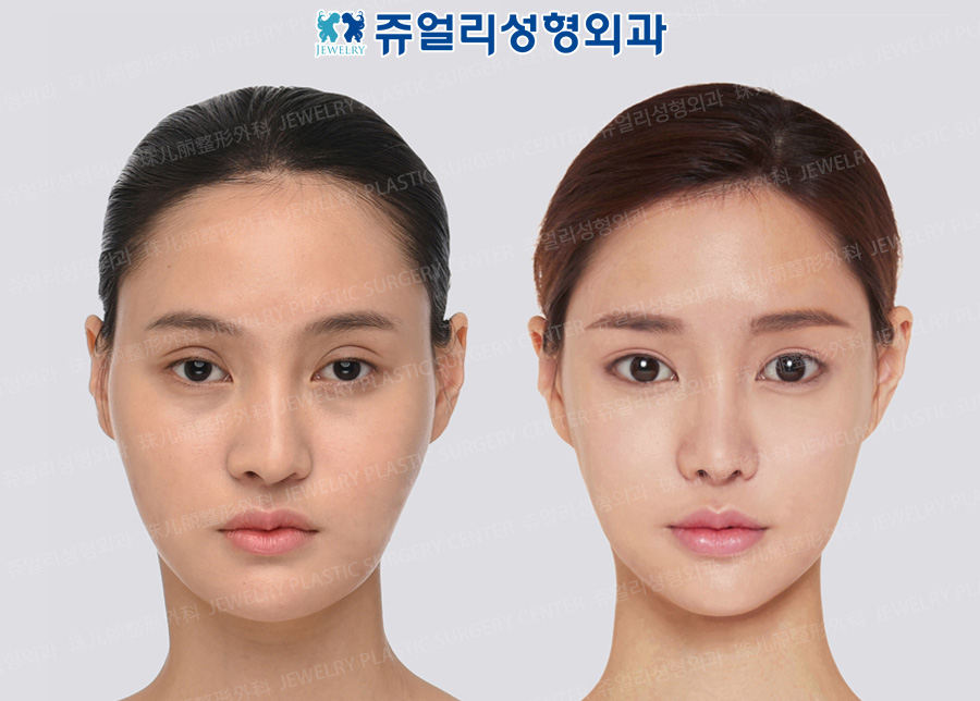 Double Eyelids Reoperation (Ptosis), Lateral Canthoplasty, Lower Lateral Canthoplasty, Dark Circle Removal+Loveband, Nose Reoperation, Fat Grafting, Double Chin Liposuction, Cheekbone Reduction+Square Jaw Reduction+T-osteotomy