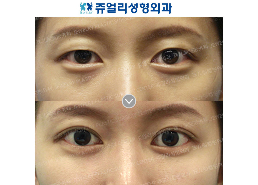 Double Eyelids + Dark Circle (Fat-Repositioning Transconjunctival)