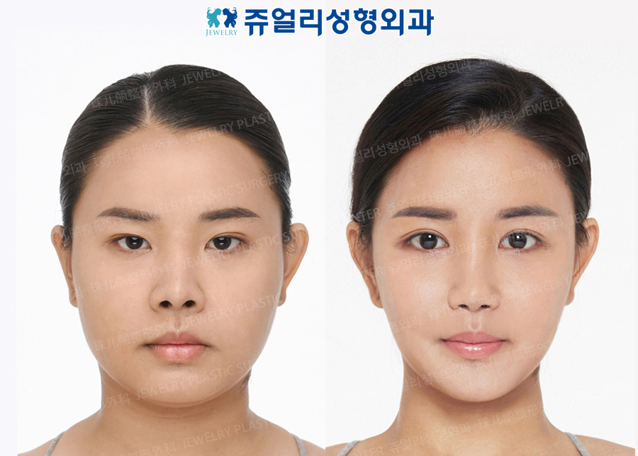 Double Eyelids (Non-Incision), Epi/Lateral/Lower Lateral Canthoplasty, Nose Reoperation, Nostrils Reduction, Chin Implant, Cheek/Chin Liposuction, Chin Botox, Smile Line Filler, Buccal Fat Removal