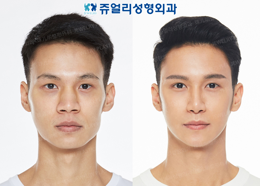 Eyes (Non-Incision, Non-Incision Ptosis Correction+Epicanthoplasty), Nose (Osteotome, Hump Nose, Nostrils Reduction), Cheek Reduction, Front Chin Implant, Square Jaws Botox