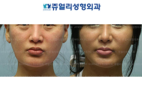 Mini Lifting (Jaw Line Lifting)