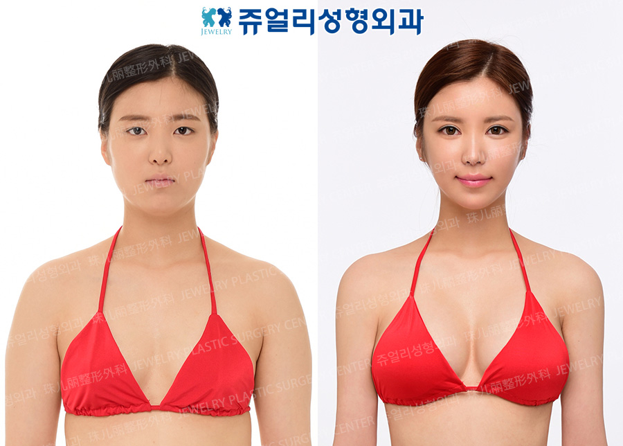 Breast Augmentation, Liposuction (Polymastia, Arm)