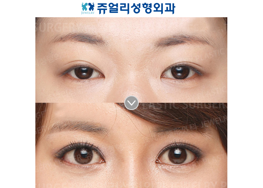 Ptosis Correction + Ptosis