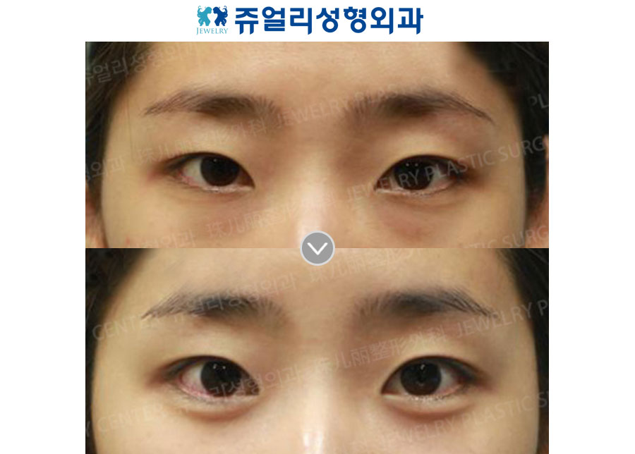 Fat-Repositioning Transconjunctival + Loveband