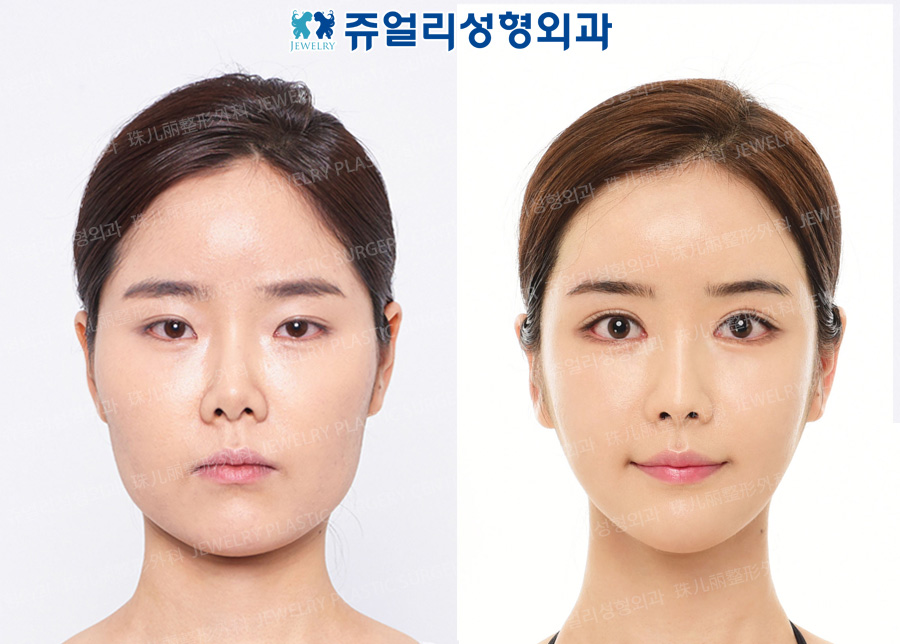 Eyes Surgery+Nose Surgery+Cheekbone Reduction+Square Jaws Reduction+Polymastia Removal+Fat Grafting