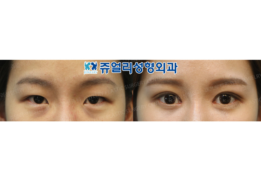 Double Eyelids Non-Incision + Epicanthoplasty + Dark Circle (Fat-Repositioning Transconjunctival)
