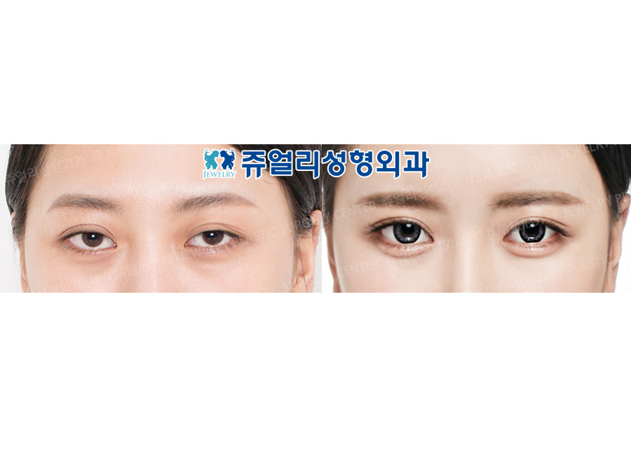Double Eyelids Incision