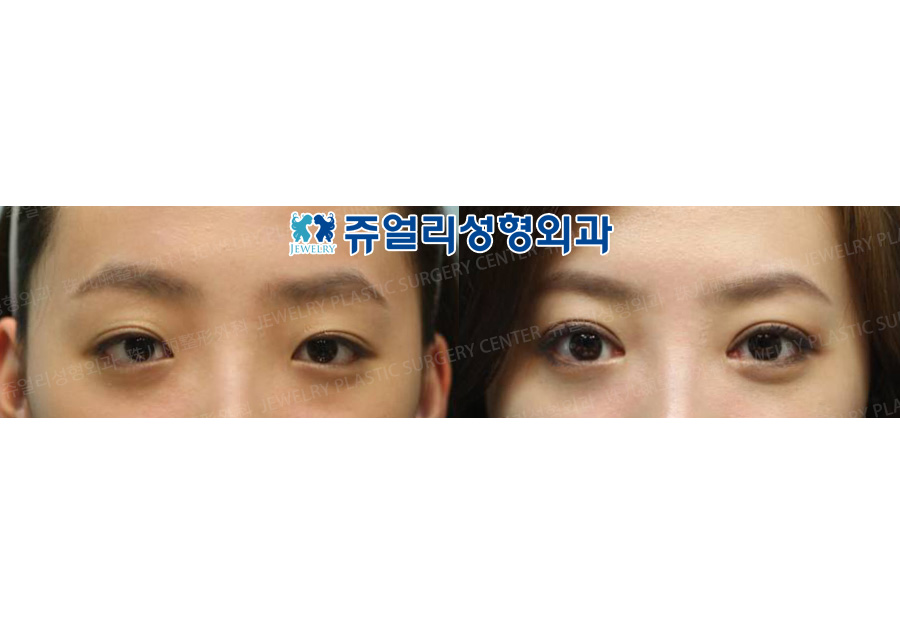 Double Eyelids Non-Incision