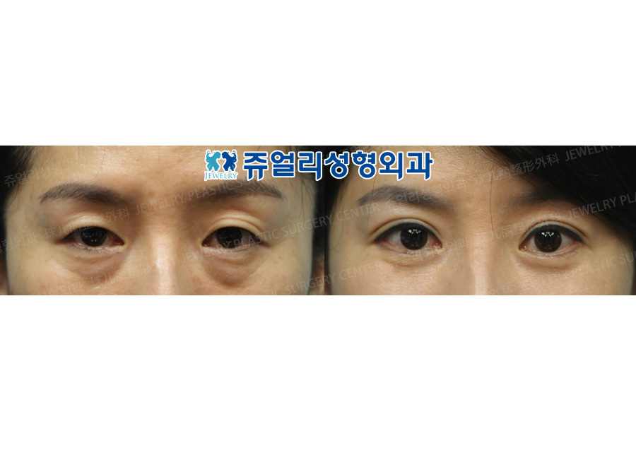Double Eyelid Incision