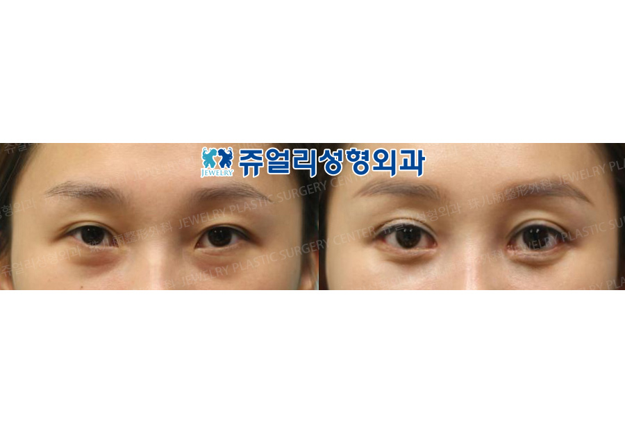 Double Eyelids Incision (Out-Line)