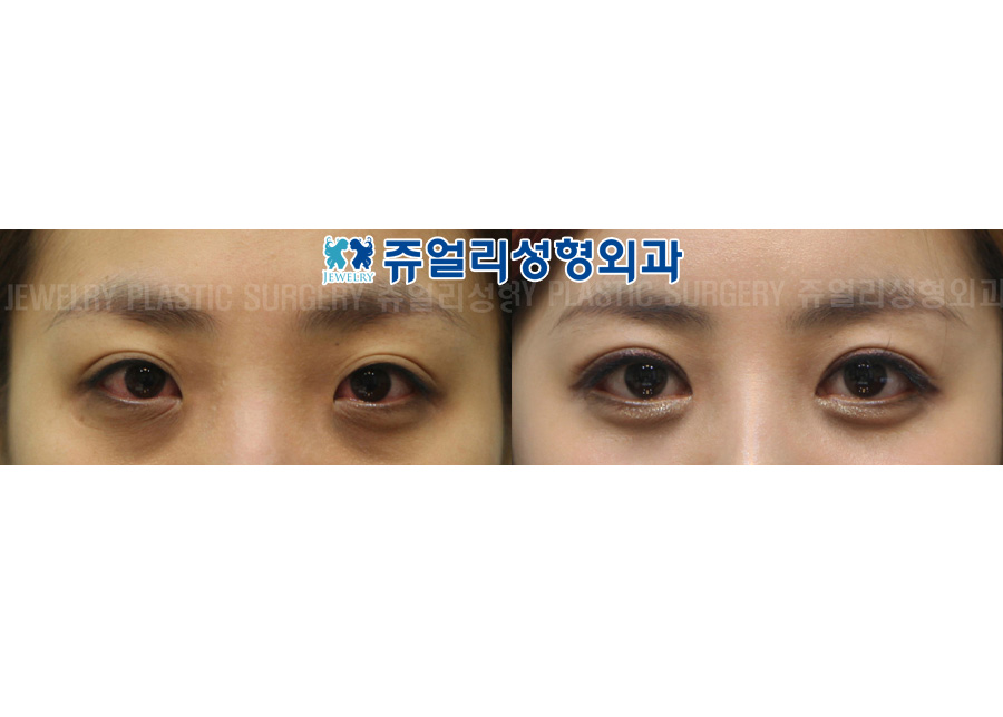 Double Eyelids Non-Incision