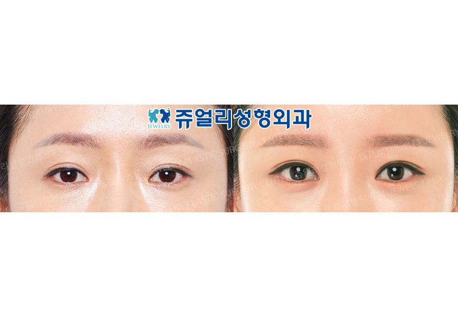 Incision Reoperation + Ptosis