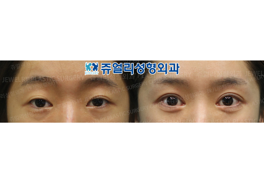 Incision Reoperation + Ptosis