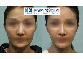 Double Chin & Cheek Liposuction + Jaw Line Lifting + Chin Botox